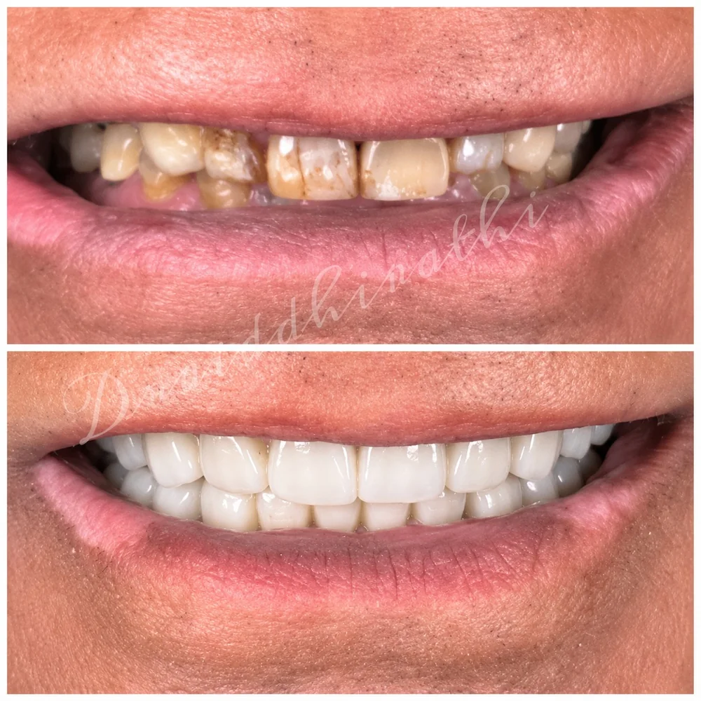 Before and after: heavily worn and decayed teeth, rebuilt as a full upper and lower restoration